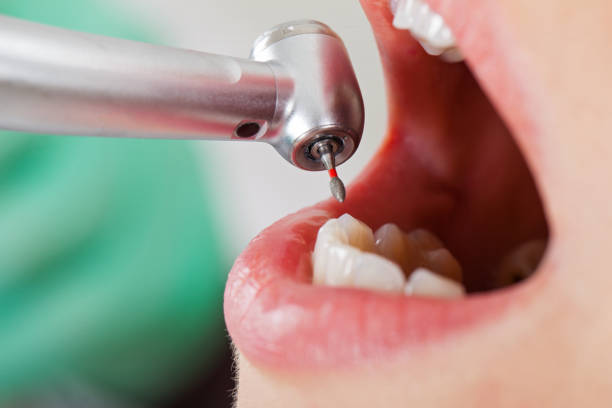 Best Emergency Dental Extractions in Glendale Heights, IL